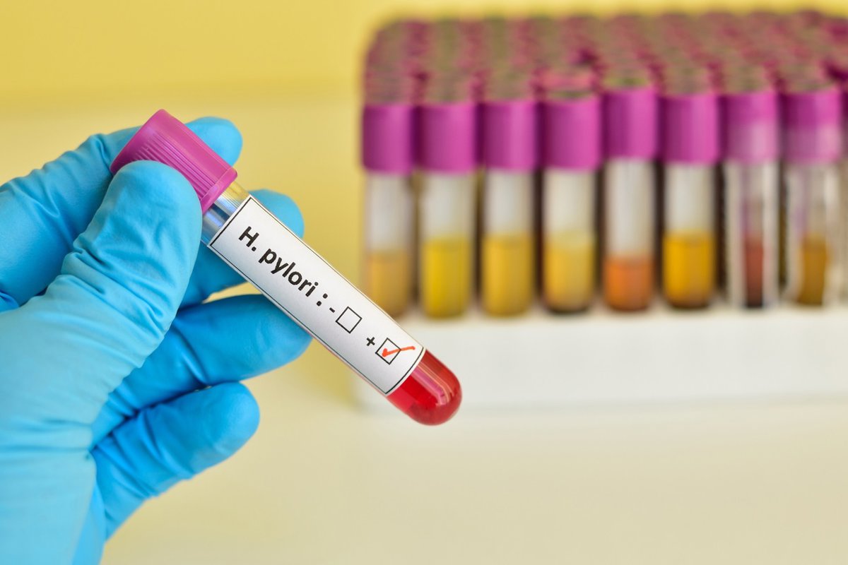 Eliminar la bacteria H. pylori disminuye el riesgo de úlceras y cáncer gástrico en pacientes
