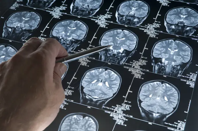 Detectan señales en el cerebro que pueden prever el Alzheimer antes de su diagnóstico clínico