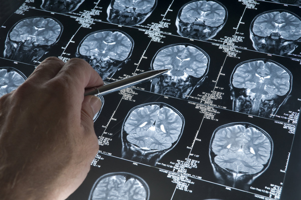 Una nueva vía terapéutica para combatir el Alzheimer a través del intestino