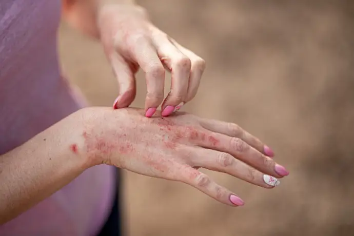 Adultos con eczema atópico tienen un mayor riesgo de pensamientos suicidas