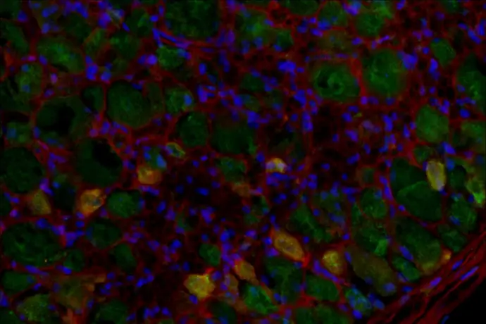Inhibir la glutaminasa podría aliviar el dolor neuropático crónico en personas sin tratamiento