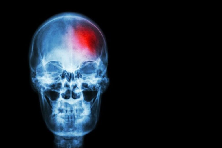 Día Mundial del Ictus: la SEN advierte sobre su efecto en la salud y la necesidad de