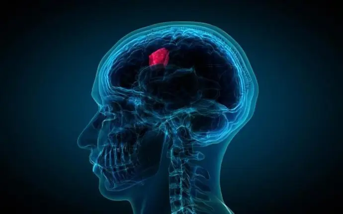 Una nueva terapia muestra un 40% más de supervivencia en pacientes con glioblastoma