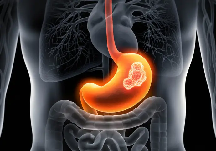 Acceso equitativo y ágil a diagnósticos y tratamientos innovadores en cáncer gástrico