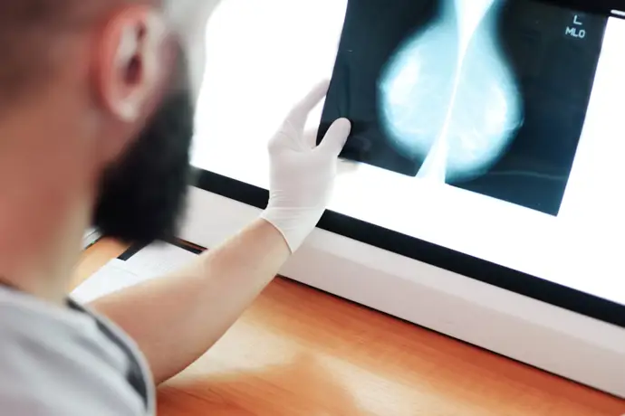 Omitir la biopsia del ganglio centinela no afecta la supervivencia en cáncer de mama temprano