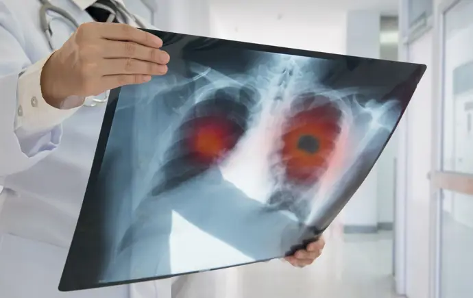 Causas de la detección tardía del cáncer de pulmón en algunas comunidades y posibles soluciones