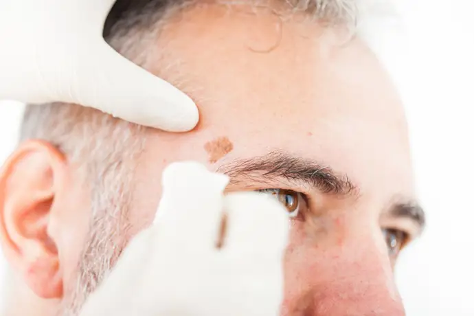 una menor dosis de inmunoterapia podría aumentar la supervivencia en pacientes con melanoma