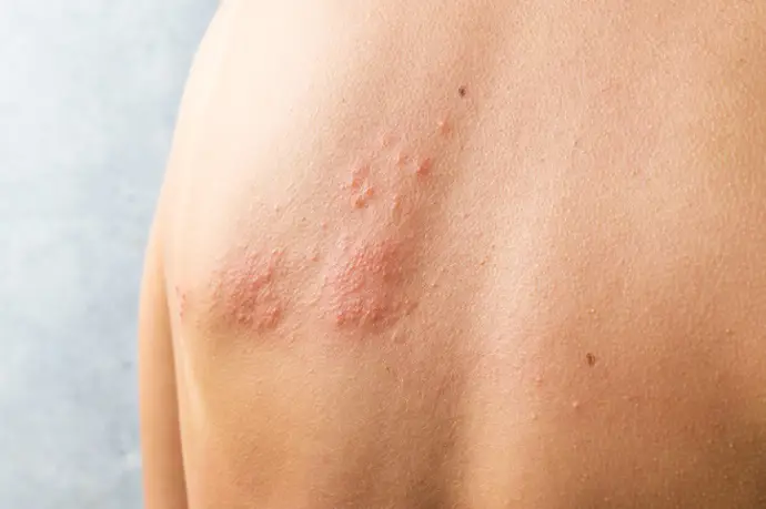 Investigación de Harvard sugiere un nuevo enfoque para combatir cepas resistentes del herpes