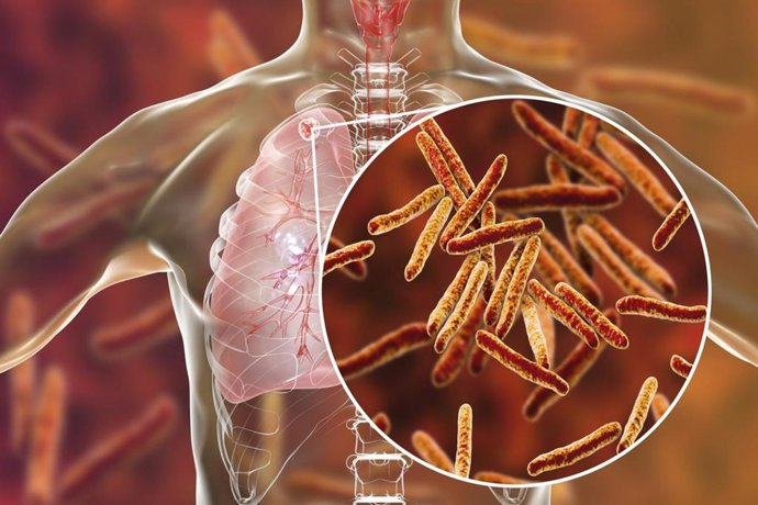 Archivo - Imagen de recurso de la tuberculosis.