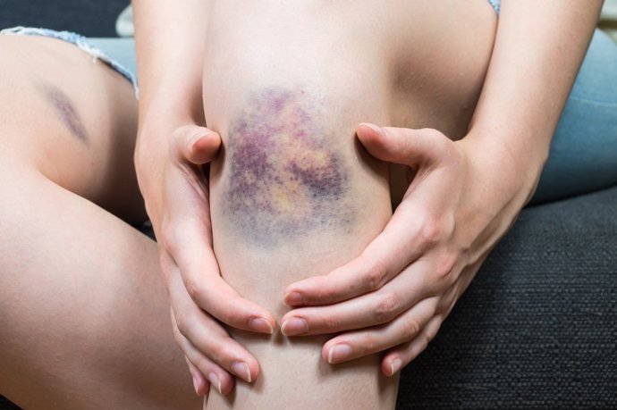 Archivo - Imagen de recurso de una persona con un hematoma.