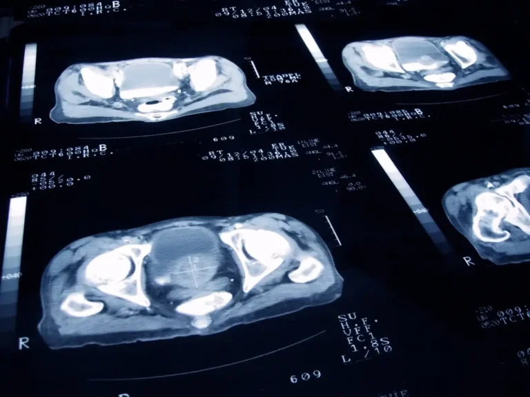 Diferencias en la sangre explican la respuesta racial a los fármacos en el cáncer de próstata