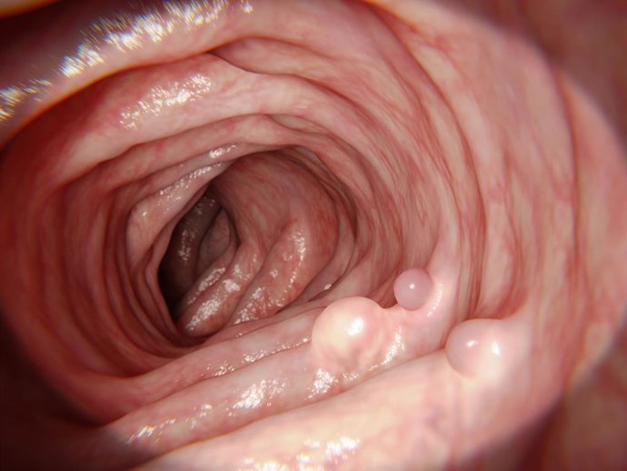 Archivo - P&oacute;lipos intestinales