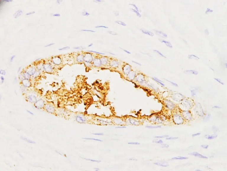 Investigadores españoles desarrollan un test para detectar cáncer de páncreas en minutos con