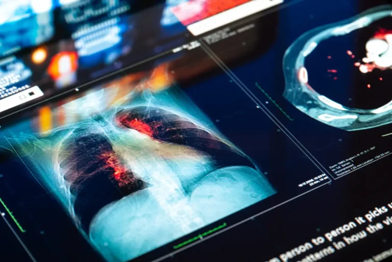Científicos descubren cómo activar células asesinas en el tratamiento del cáncer de pulmón