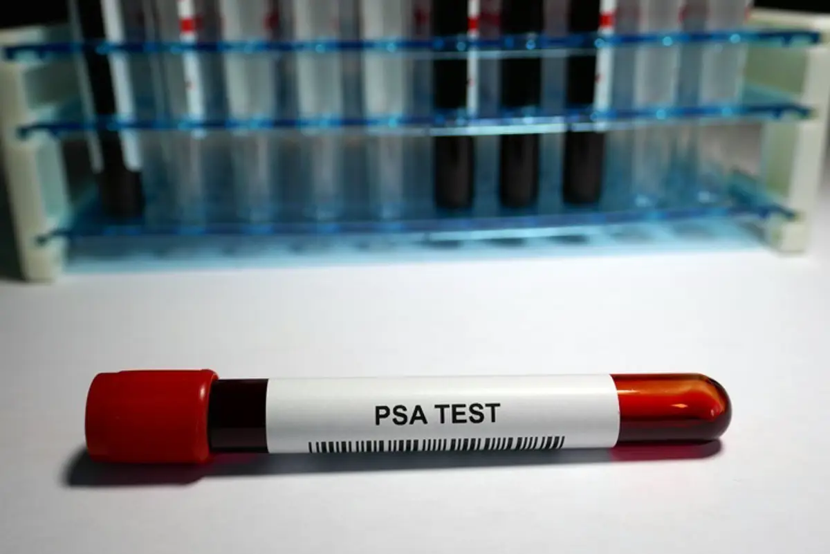 Urólogos resaltan que anticiparse es la clave contra el cáncer de próstata
